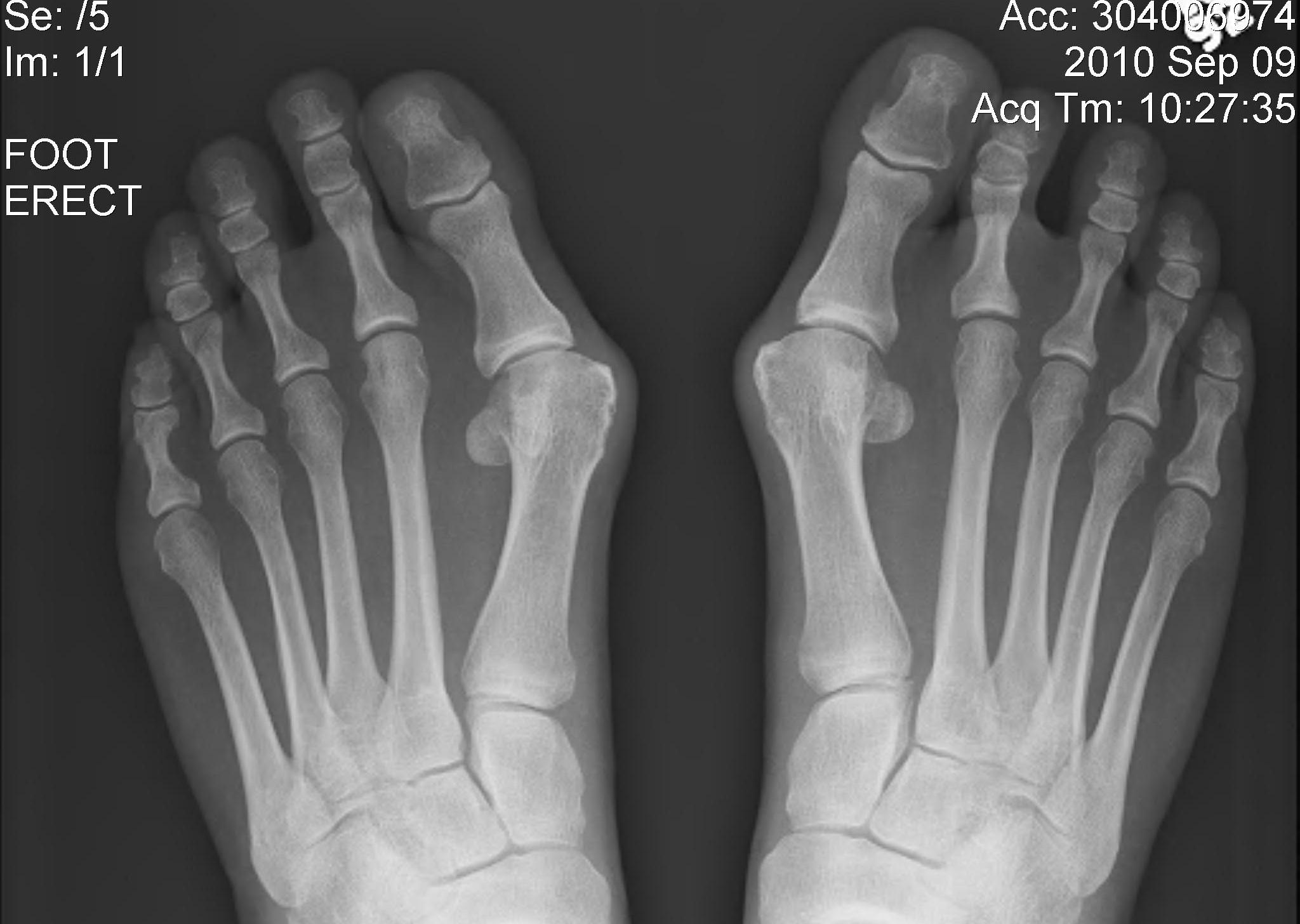 Hallux Valgus Mild